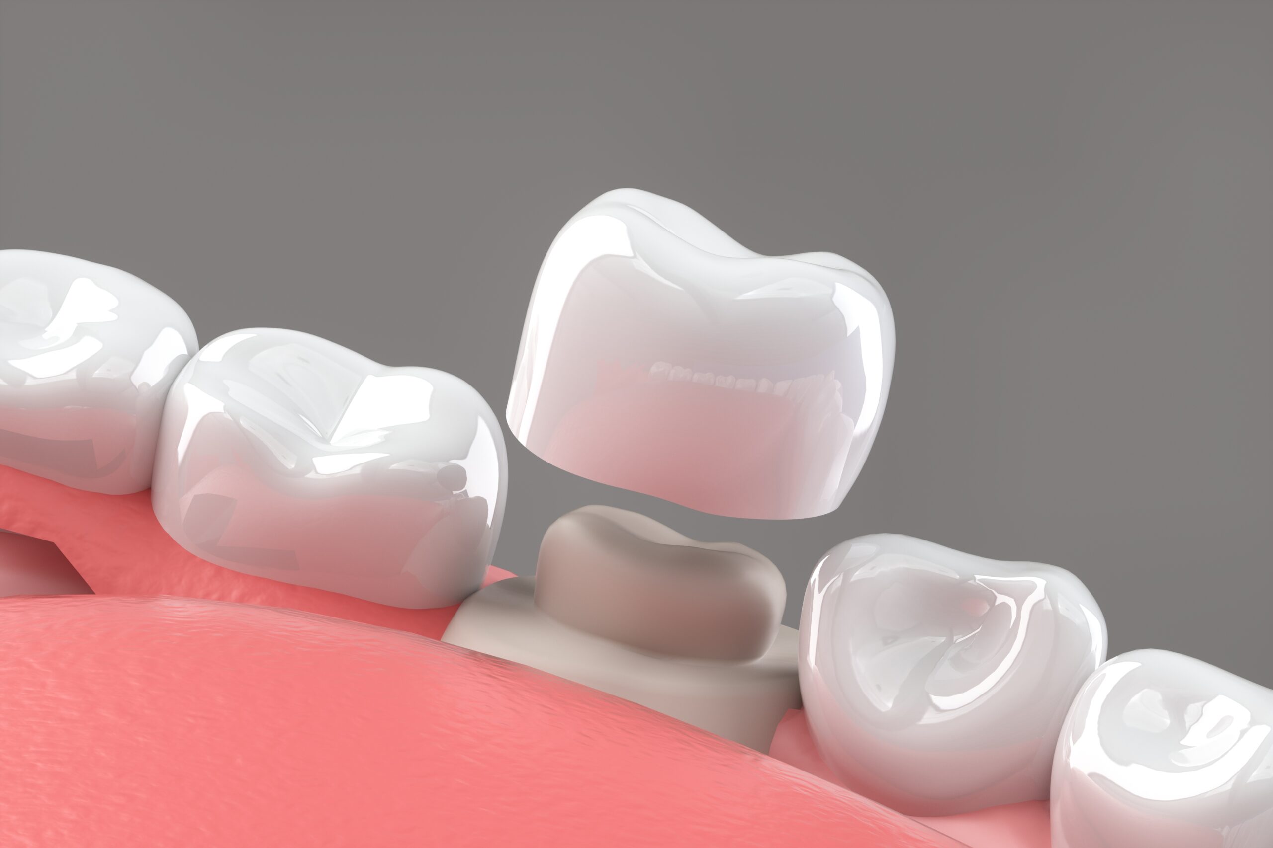 Lifespan of Dental Crowns