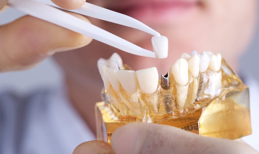 Impact of Dental Implants on Oral Health