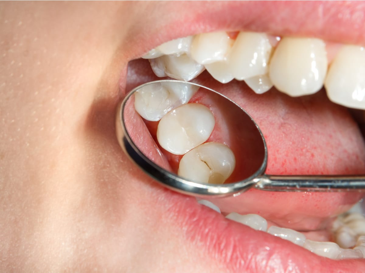 Preventing Tooth Decay