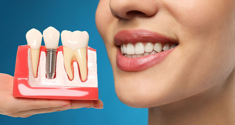 Exploring the Benefits of a Tooth Replacement