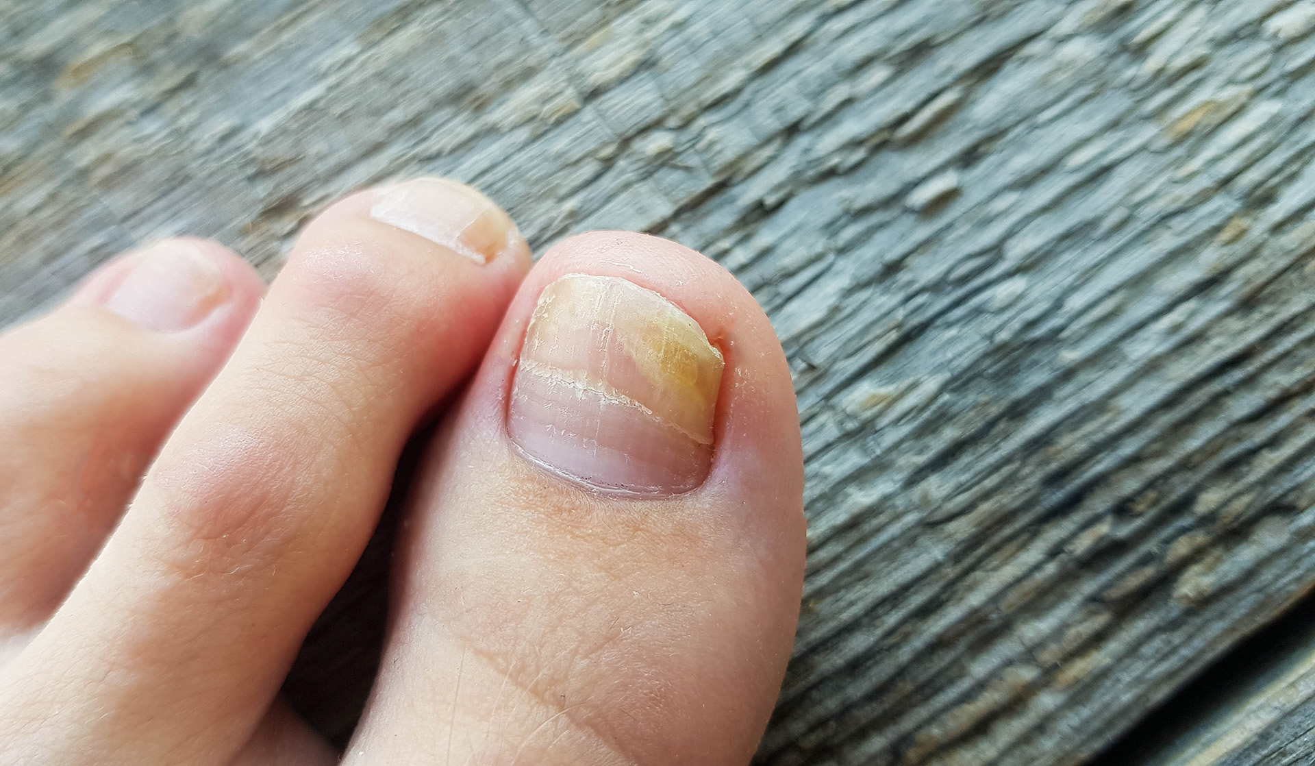 Fungal Nail Issues