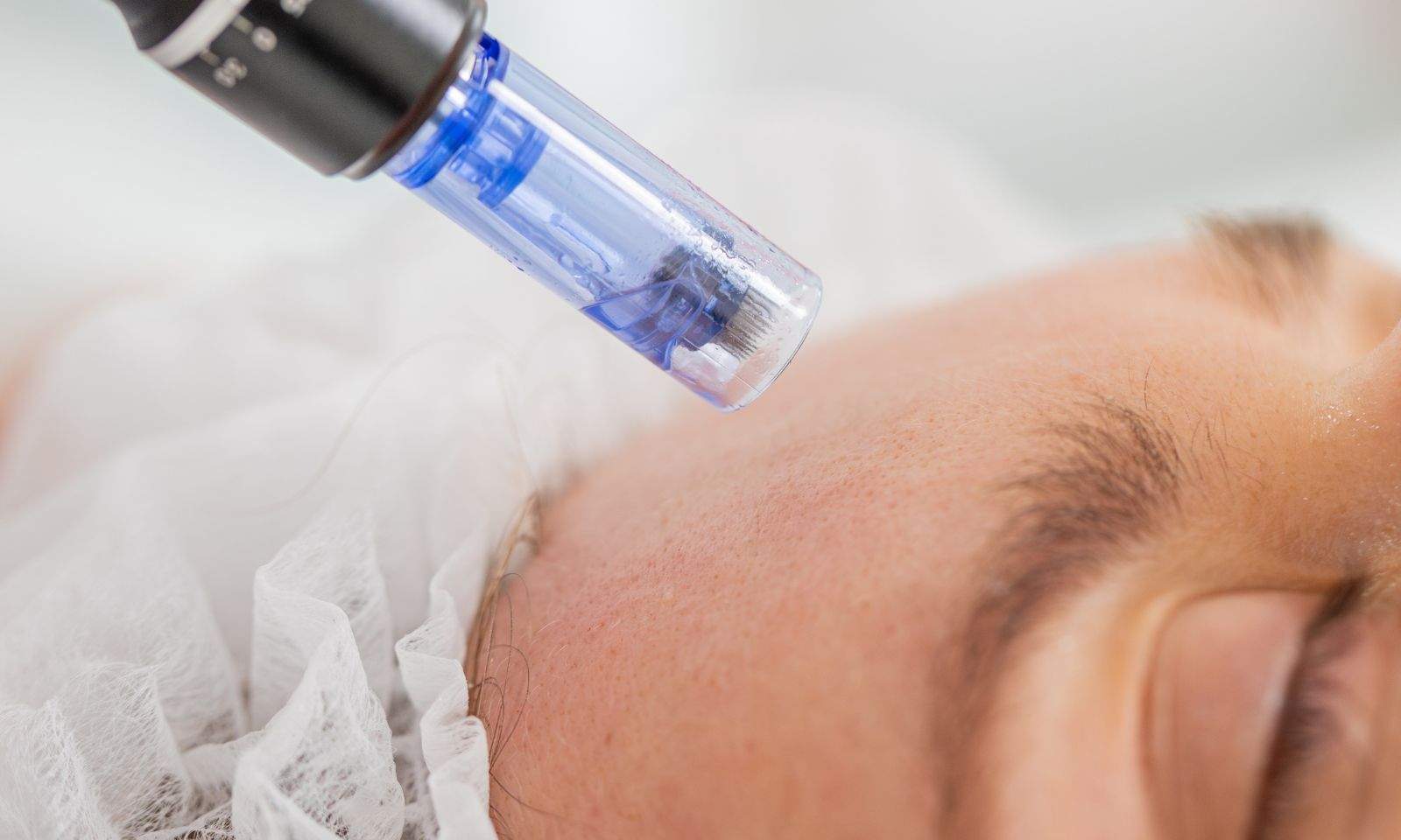 Microneedling Treatment