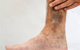 Effective Strategies for Preventing Venous Ulcers